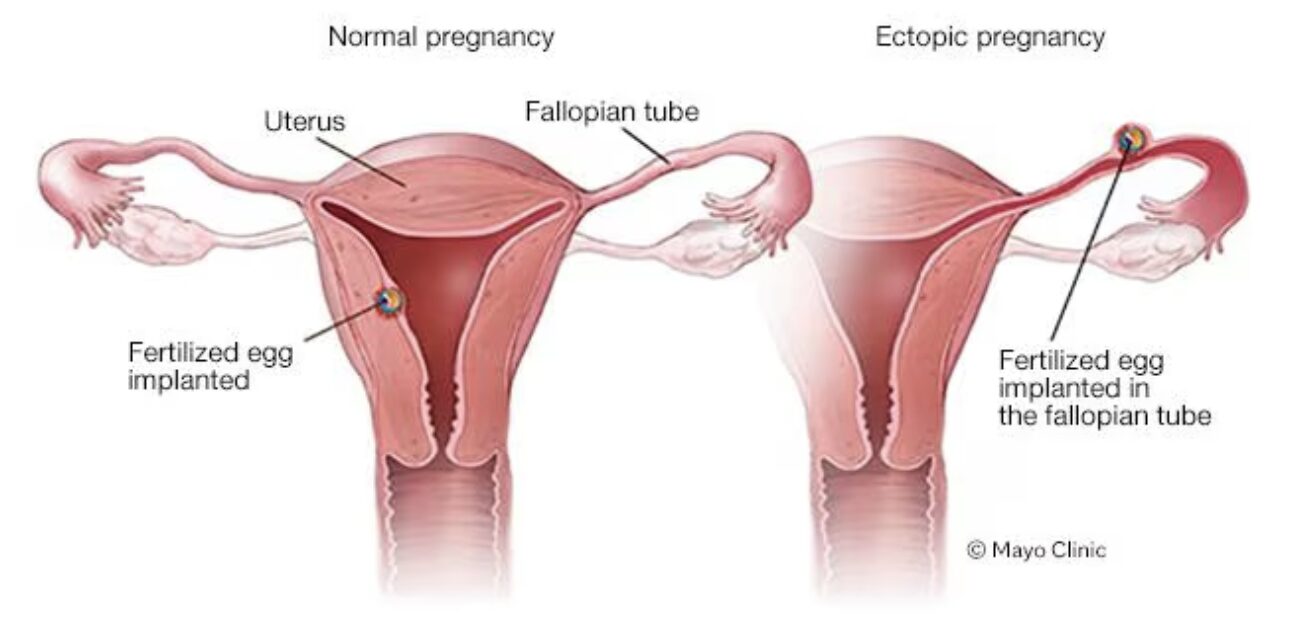 ectopic pregnancy diagram